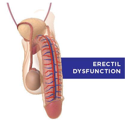Part 1 of Erectile Dysfunction